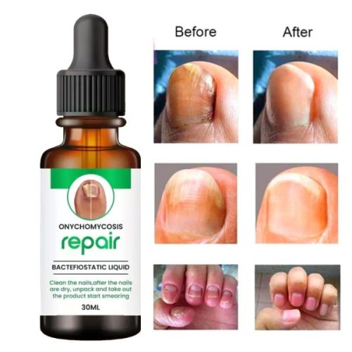Nail Repair & Ingrown Toenail Care Serum Kit